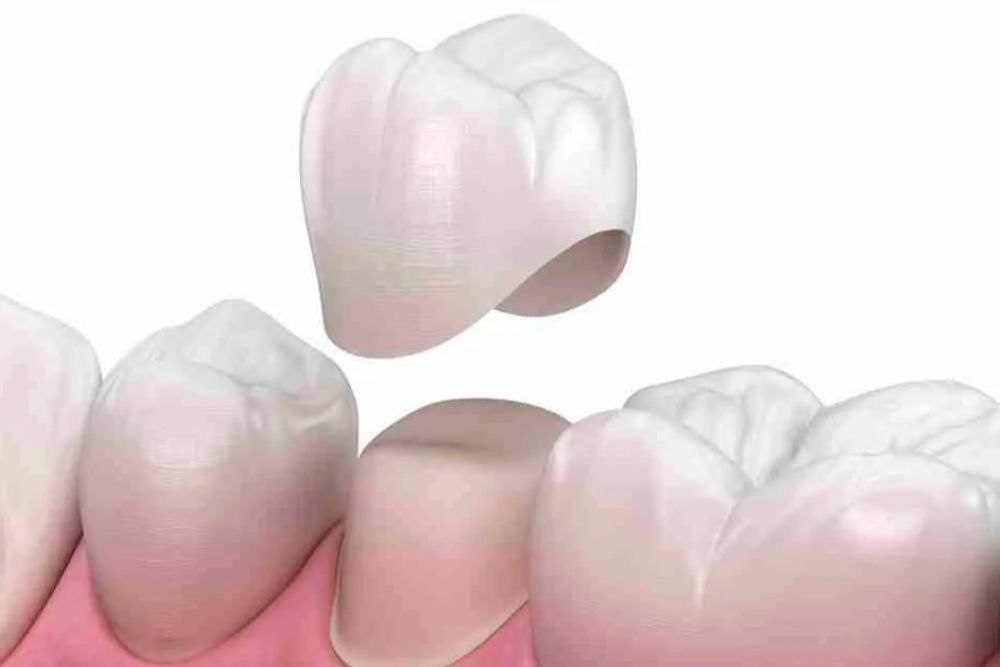 Crowns in Brandon Florida