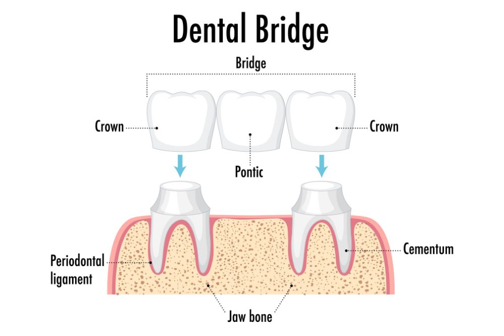 Dental Bridges in Brandon Florida
