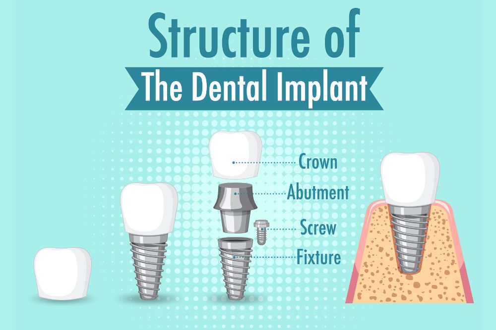 Dental Implant in Brandon Florida