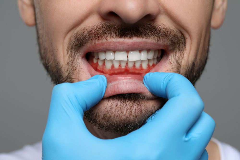 Gum Disease