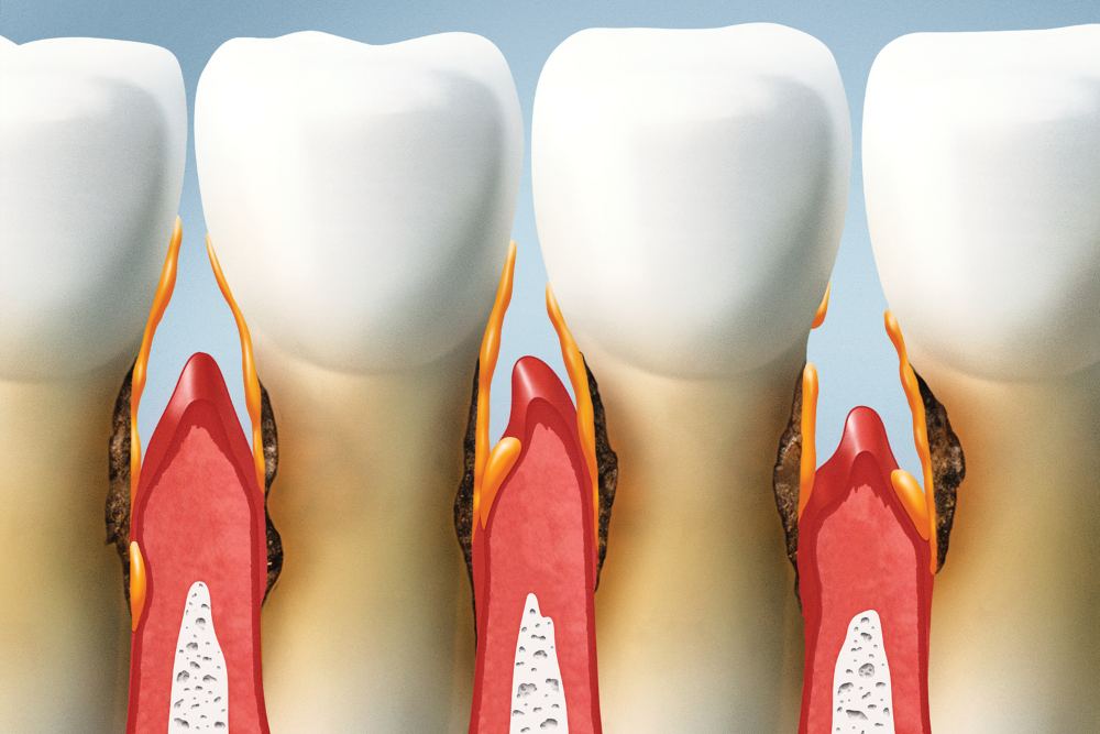 Gum Disease
