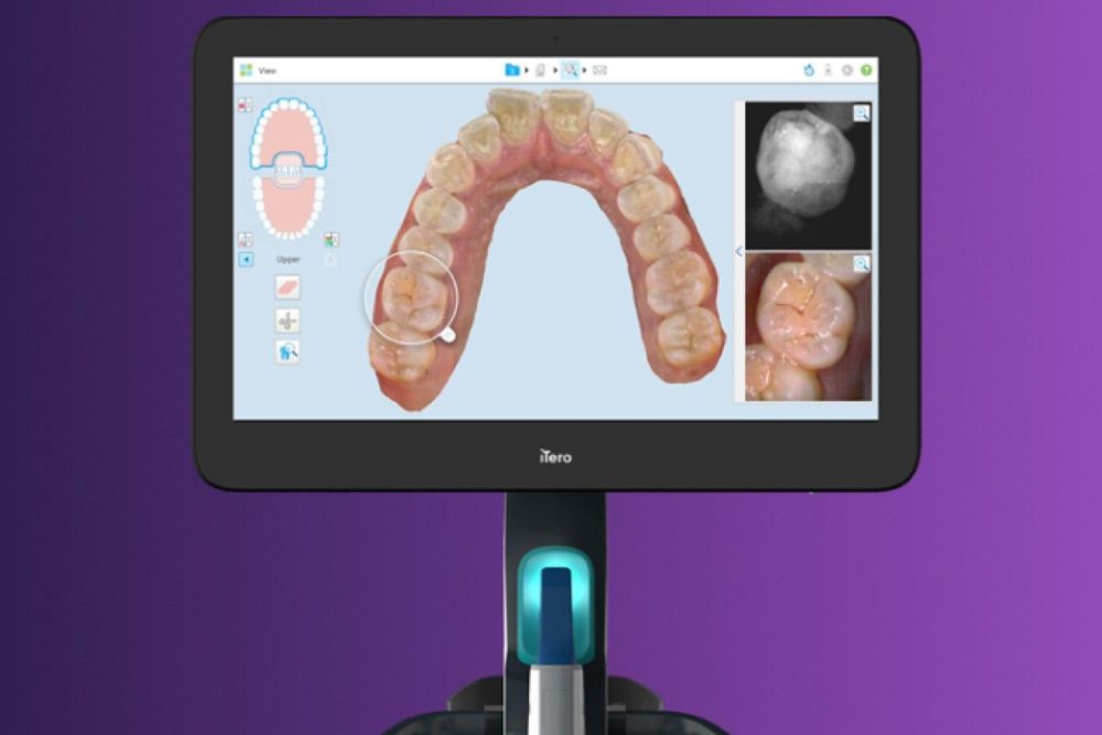 Itero Lumina Intra-Oral Scanner Screen